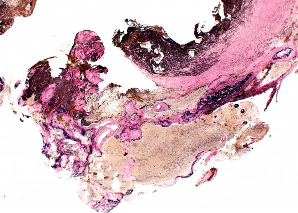 13A2 Radiation Necrosis of AVM 10 years after Rx (Case 13) VVG C1 WM A