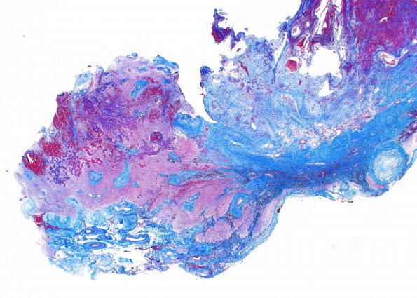 13A3 Radiation Necrosis of AVM 10 years after Rx (Case 13) C1 Trichrome 2X A