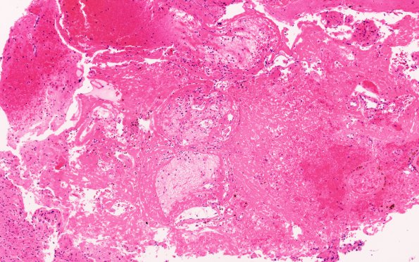 13B1 Radiation Necrosis of AVM 10 years after Rx (Case 13) H&E C1 10X