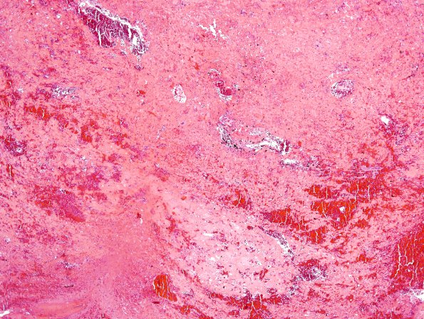 13B2 Radiation Necrosis of AVM 10 years after Rx (Case 13) H&E 2