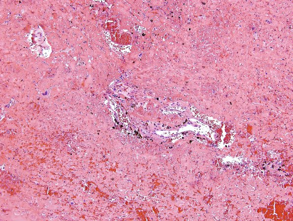 13B3 Radiation Necrosis of AVM 10 years after Rx (Case 13) H&E 1