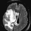 1A1 Radiation Necrosis (Case 1) TIRM BLADE 1 - Copy