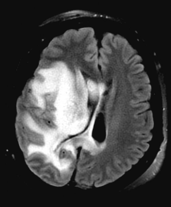 1A1 Radiation Necrosis (Case 1) TIRM BLADE 1 - Copy