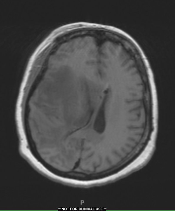 1A2 Radiation Necrosis (Case 1) T1 no contrast - Copy