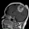 1A3 Radiation Necrosis (Case 1) T1 with contrast - Copy