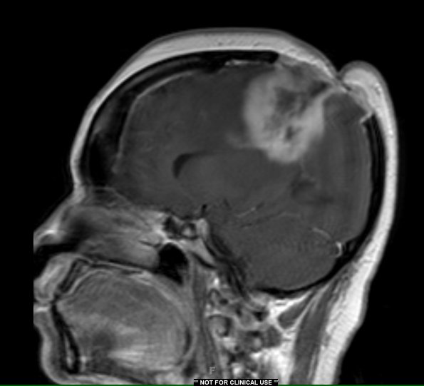 1A3 Radiation Necrosis (Case 1) T1 with contrast - Copy