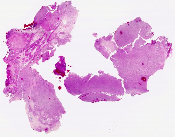 1B1 Radiation Necrosis (Case 1) H&E whole mount 3