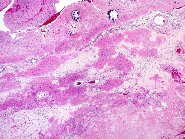 1B2 Radiation Necrosis (Case 1) H&E 2