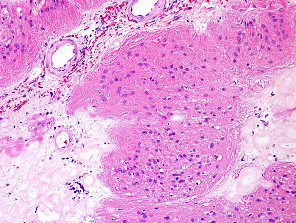 1B3 Radiation Necrosis (Case 1) H&E 3