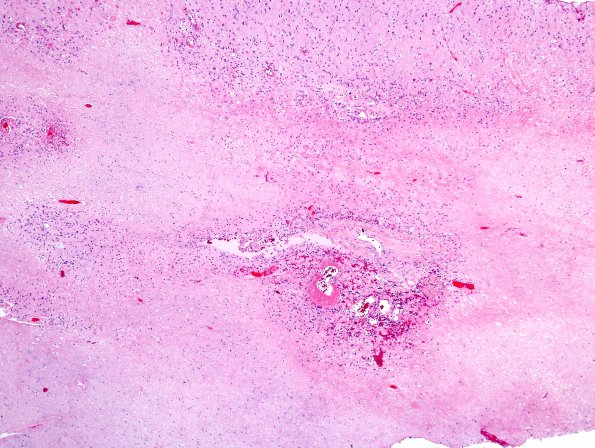 1B5 Radiation Necrosis (Case 1) H&E 6