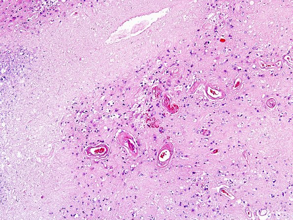 1B6 Radiation Necrosis (Case 1) H&E 5