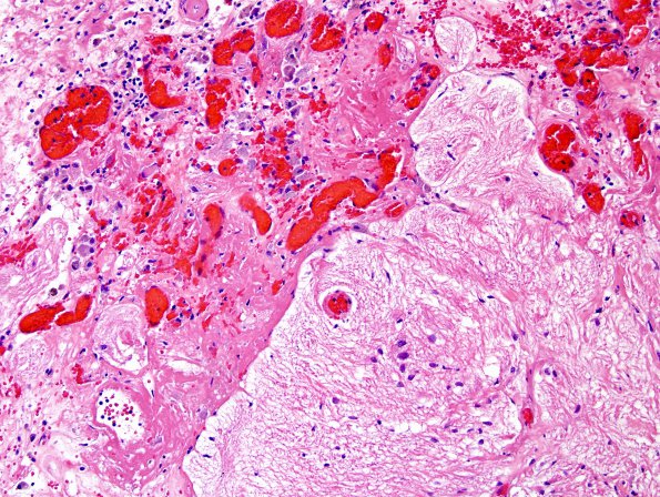 1B7 Radiation Necrosis (Case 1) H&E 4