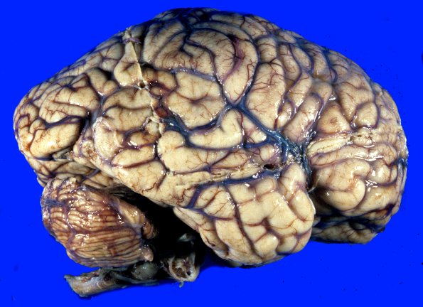 2A1 Radiation Encephalopathy (Case 2) 1