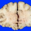 2A2 Radiation Encephalopathy (Case 2) 3