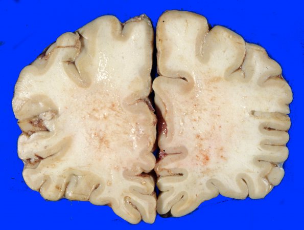 2A2 Radiation Encephalopathy (Case 2) 3