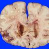 2A3 Radiation Encephalopathy (Case 2) 9