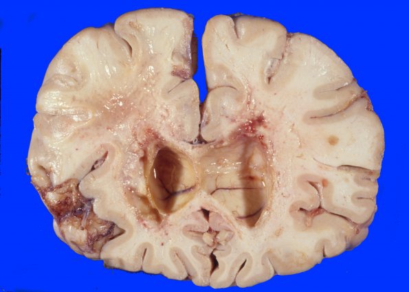 2A3 Radiation Encephalopathy (Case 2) 9