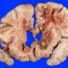 2A4 Radiation Encephalopathy (Case 2) 1A