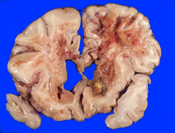 2A4 Radiation Encephalopathy (Case 2) 1A