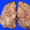 2A5 Radiation Encephalopathy (Case 2) 5