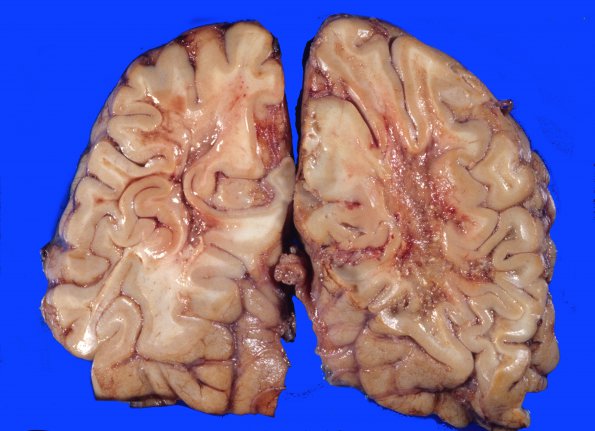 2A5 Radiation Encephalopathy (Case 2) 5