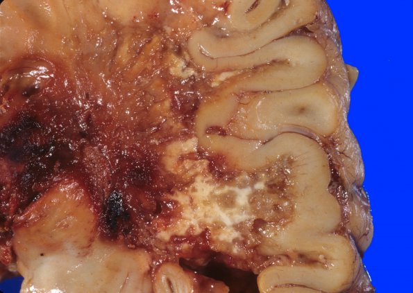 2A6 Radiation Encephalopathy (Case 2) 7