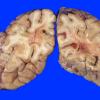 2A7 Radiation Encephalopathy (Case 2) 4