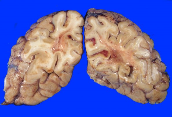 2A7 Radiation Encephalopathy (Case 2) 4