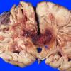 2A8 Radiation Encephalopathy (Case 2) 6 copy