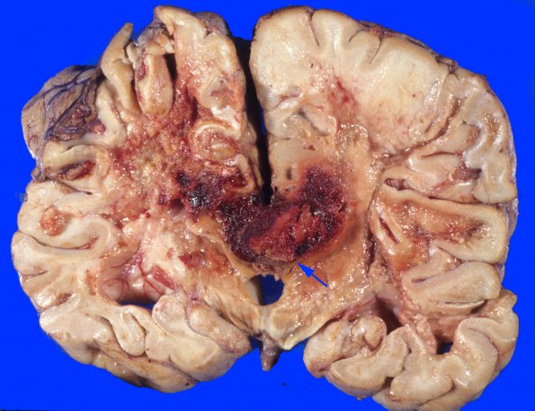 2A8 Radiation Encephalopathy (Case 2) 6 copy