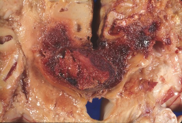 2A9 Radiation Encephalopathy (Case 2) 10