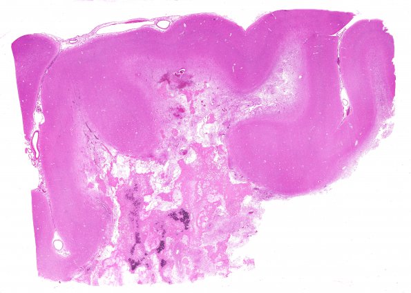 2B1 Radiation Leukoencephalopathy (Case 2) H&E I WM