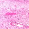 2B3 Radiation Leukoencephalopathy (Case 2) H&E 4