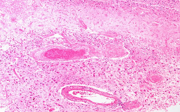 2B3 Radiation Leukoencephalopathy (Case 2) H&E 4