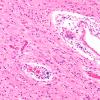 2B4 Radiation Leukoencephalopathy (Case 2) H&E 5