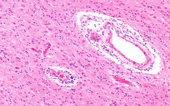 2B4 Radiation Leukoencephalopathy (Case 2) H&E 5