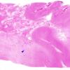 2B5 Radiation Leukoencephalopathy (Case 2) H&E whole mount E copy