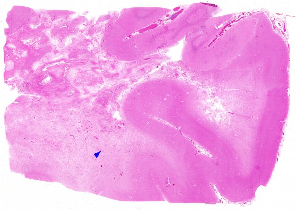 2B5 Radiation Leukoencephalopathy (Case 2) H&E whole mount E copy