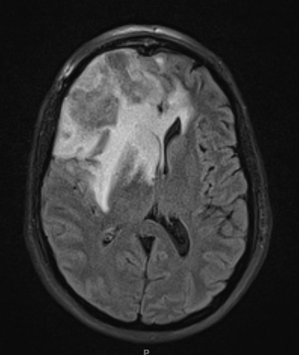 3A1 Radiation Necrosis (Case 3) T2 FLAIR 1 - Copy