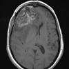 3A2 Radiation Necrosis (Case 3) T1 with contrast 1 - Copy