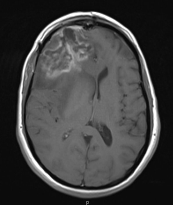 3A2 Radiation Necrosis (Case 3) T1 with contrast 1 - Copy