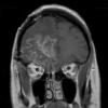 3A3 Radiation Necrosis (Case 3) T1 with contrast 2 - Copy