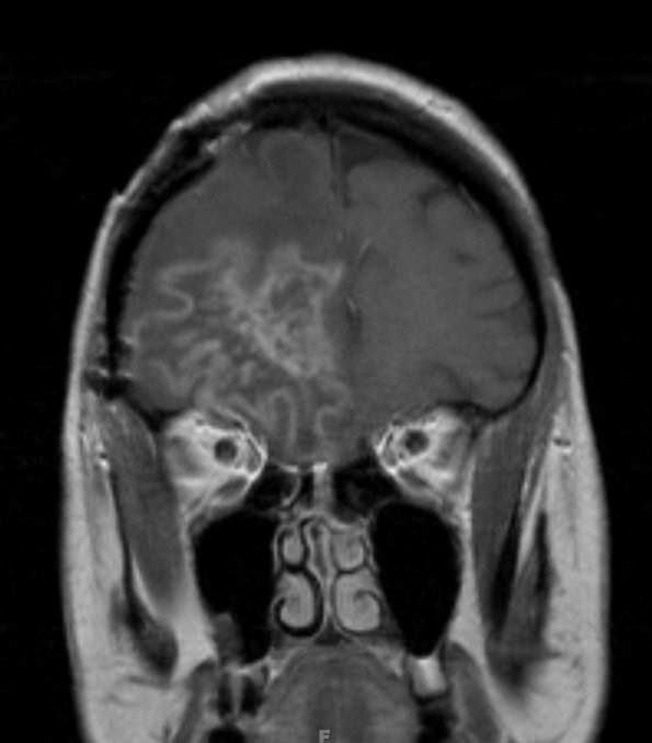 3A3 Radiation Necrosis (Case 3) T1 with contrast 2 - Copy