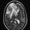 3A4 Radiation Necrosis (Case 3) T2 with contrast 1 - Copy