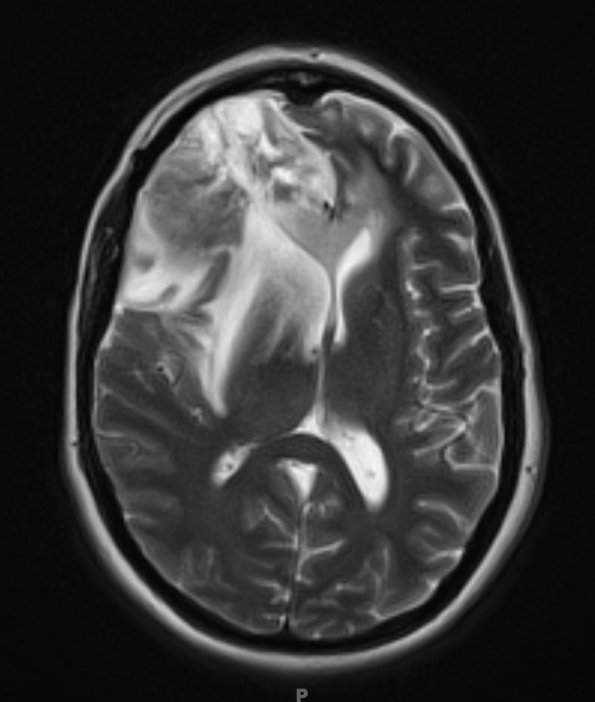 3A4 Radiation Necrosis (Case 3) T2 with contrast 1 - Copy