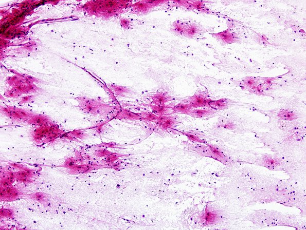 3B2 Radiation Encephalopathy (Case 3) H&E smear 4