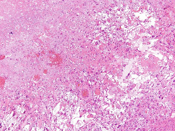 3B3 Radiation Encephalopathy (Case 3) H&E 1