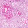 3B4 Radiation Encephalopathy (Case 3) H&E 2