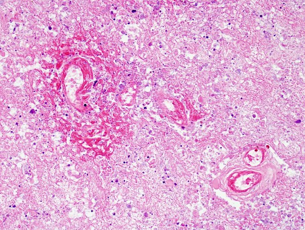 3B4 Radiation Encephalopathy (Case 3) H&E 2