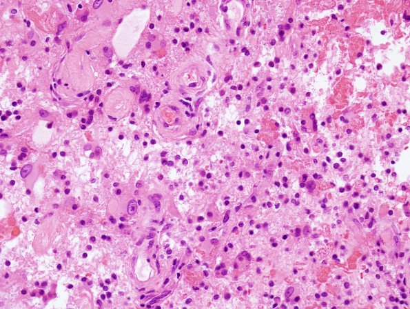 3B5 Radiation Encephalopathy (Case 3) H&E 3